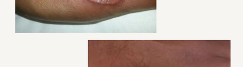 Keloid på handen